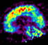 Bild på alzheimerhjärna