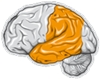 Bild på alzheimerhjärna